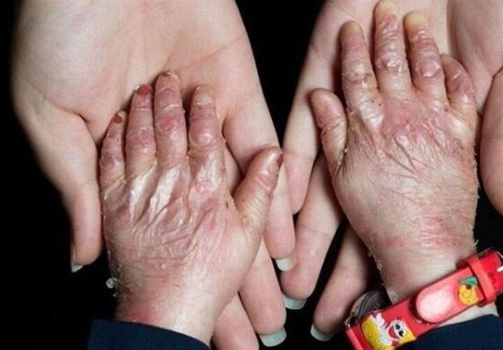 بیماران پروانه‌ای تحت پوشش خدمات رایگان دندانپزشکی قرار می‌گیرند